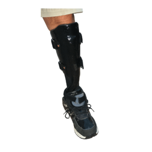 Partial foot prosthetic with t-strap on patient's left leg